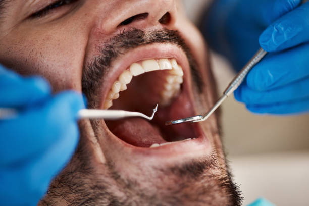 Best Emergency Tooth Extraction in Lexico, CA